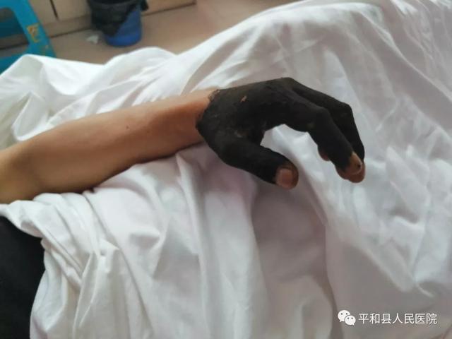 惊险！平和霞寨一村民被眼镜蛇咬伤，及时送往中医院救治-2.jpg